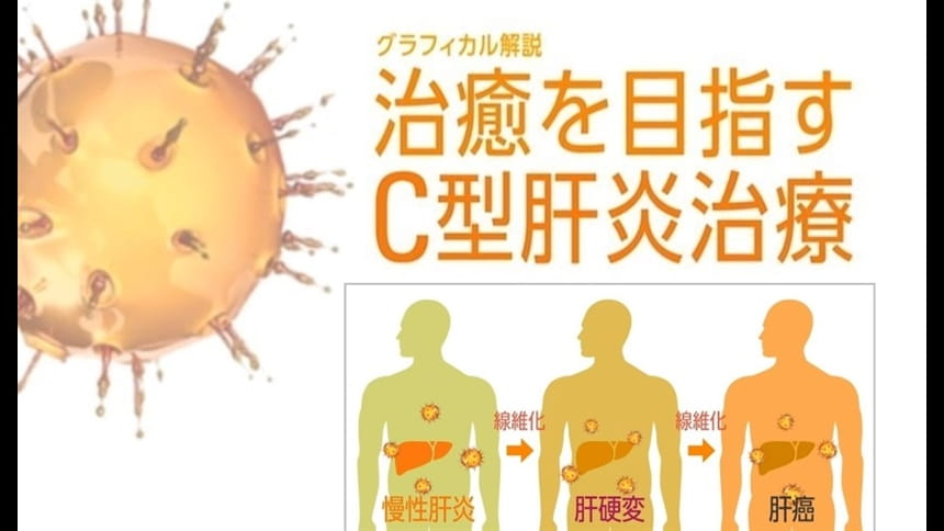 グラフィカル解説『治癒を目指すC型肝炎治療』第4回：診断と専門医への紹介基準